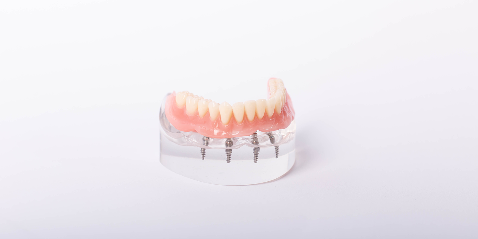 インプラントオーバーデンチャー（自費診療）