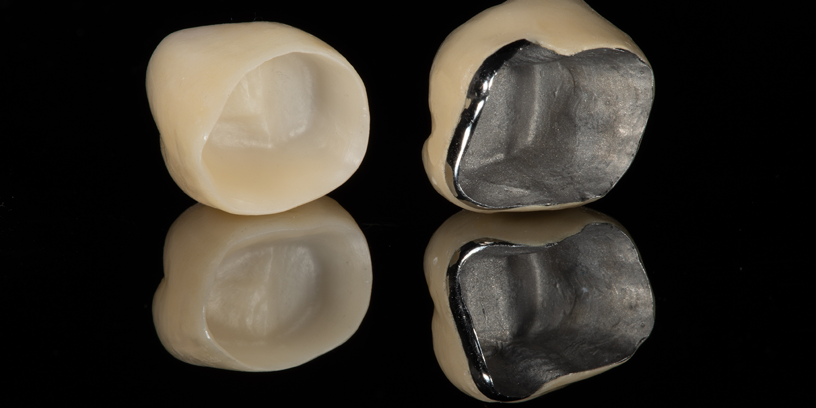 メタルボンド（陶材焼付鋳造冠）
