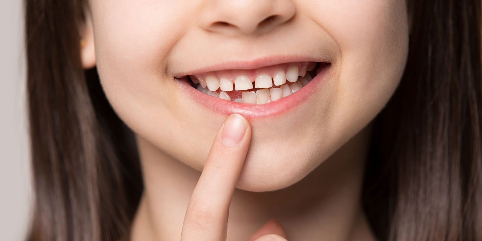 お子様の矯正（小児矯正）