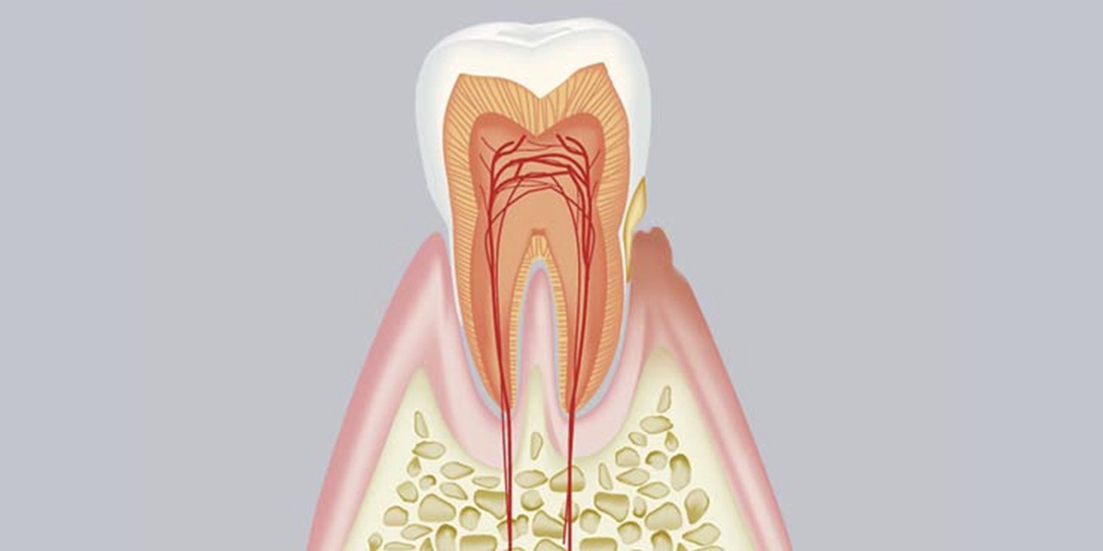 軽度歯周病（歯肉炎・軽度歯周炎）